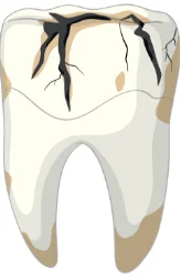 Broken Teeth