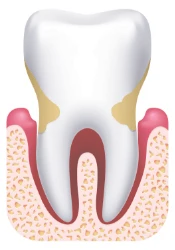 Dental Cavity