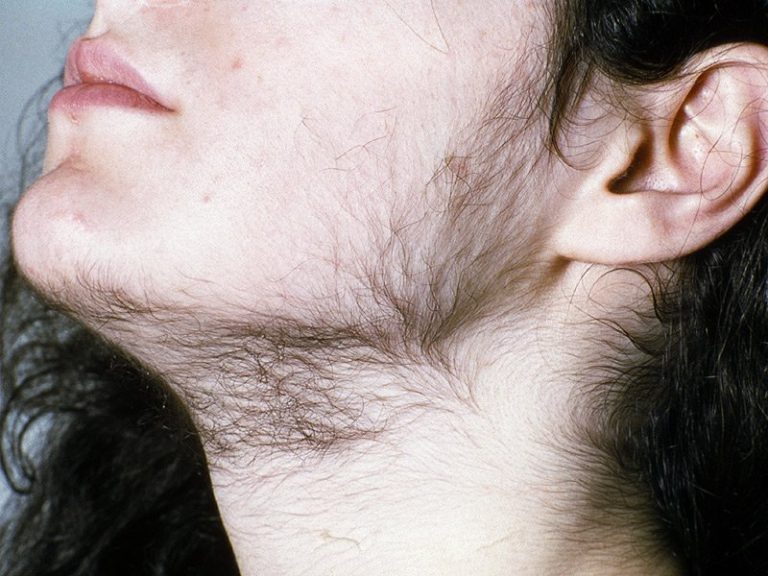 Hirsutism treatment in Lucknow, India