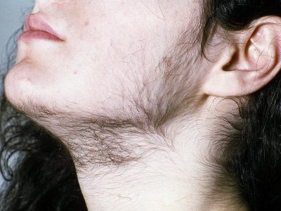 Hirsutism treatment in Lucknow, India