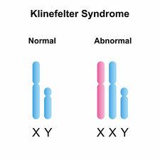 Klinefelter Syndrome Treatment in Lucknow India