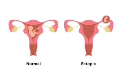 Ectopic Pregnency Treatment in Lucknow, India