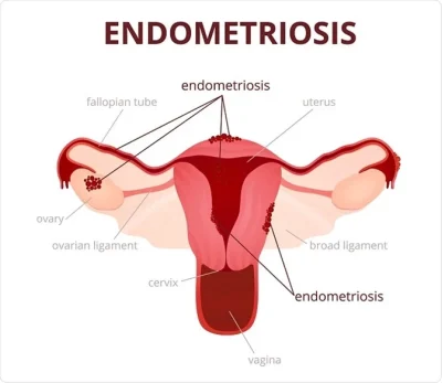endometriosis treatment in Lucknow India