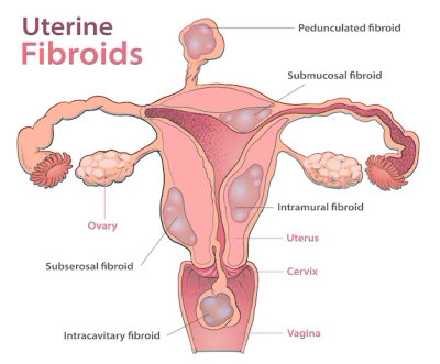 fibroids treatment in lucknow india
