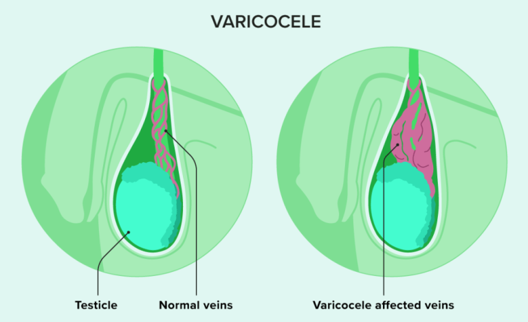 varicocele treatment in Lucknow India