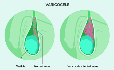 varicocele treatment in Lucknow India