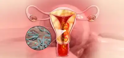 Genital Tuberculosis treatment in Lucknow India