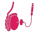 Micro-TESE Treatment in Lucknow India
