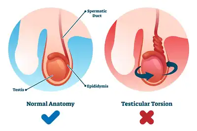 Testicular Torision treatment in Lucknow India